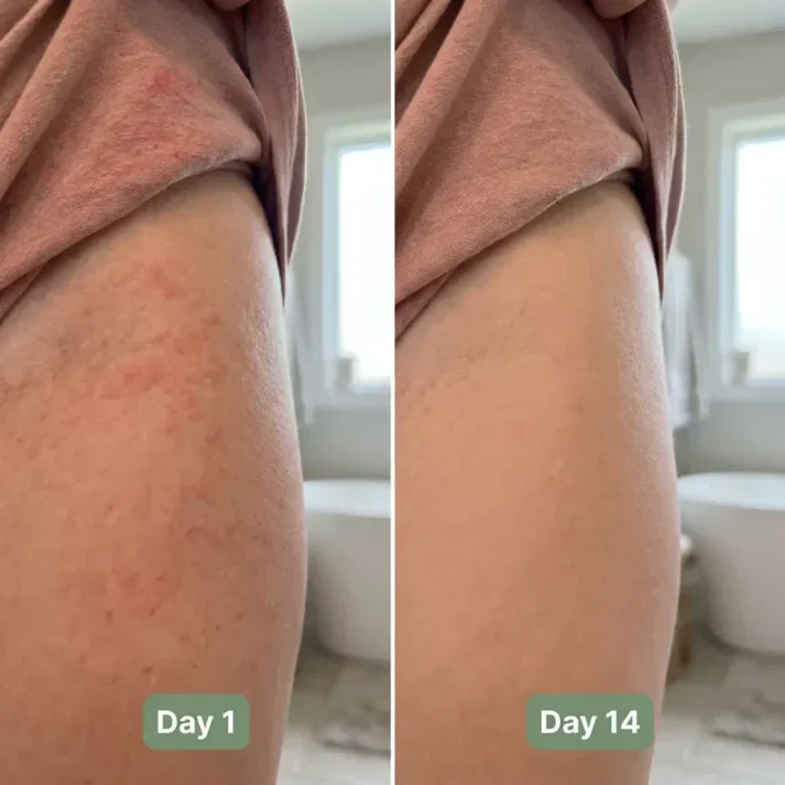🔥 LAST DAY BUY 1 GET 1 FREE🔥Intertrigo Relief Cream treats 99% of skin fold rashes from the first application SevoreaTMIntertrigo Cream🛒