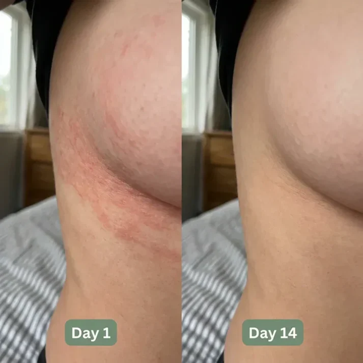 🔥 LAST DAY BUY 1 GET 1 FREE🔥Intertrigo Relief Cream treats 99% of skin fold rashes from the first application SevoreaTMIntertrigo Cream🛒